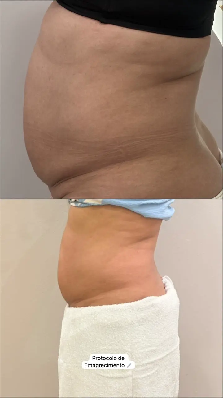 Antes e depois do protocolo facial de flacidez