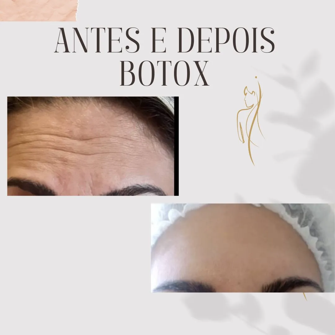 Botox antes e depois