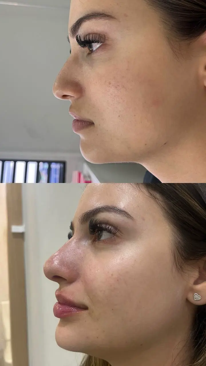 Antes e depois de rinoplastia não-cirúrgica
